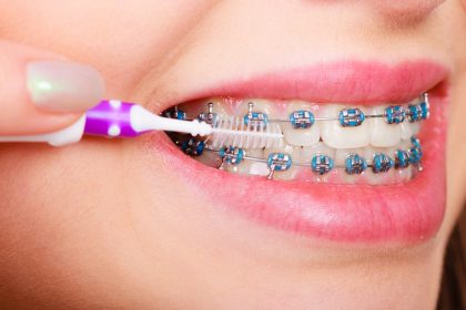 Consejos De Higiene Oral Con Ortodoncia